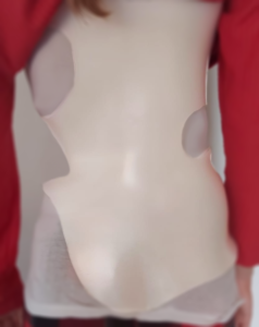 Corset de scoliose